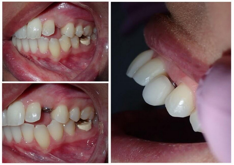 What To Do If Dental Implant Is Infected?