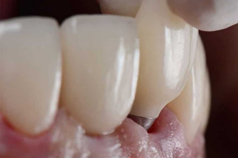 need a dental implant_3