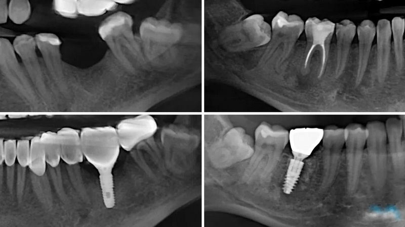 get a dental implant_3