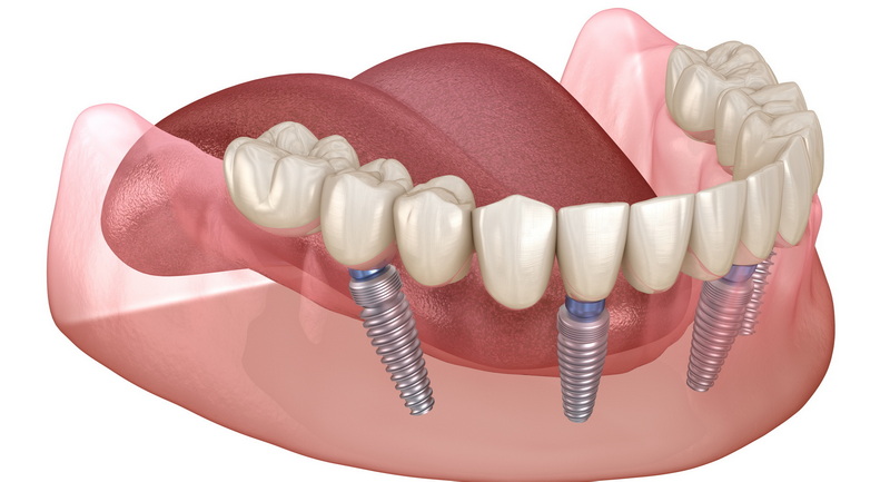 what bone graft for a dental implant_3