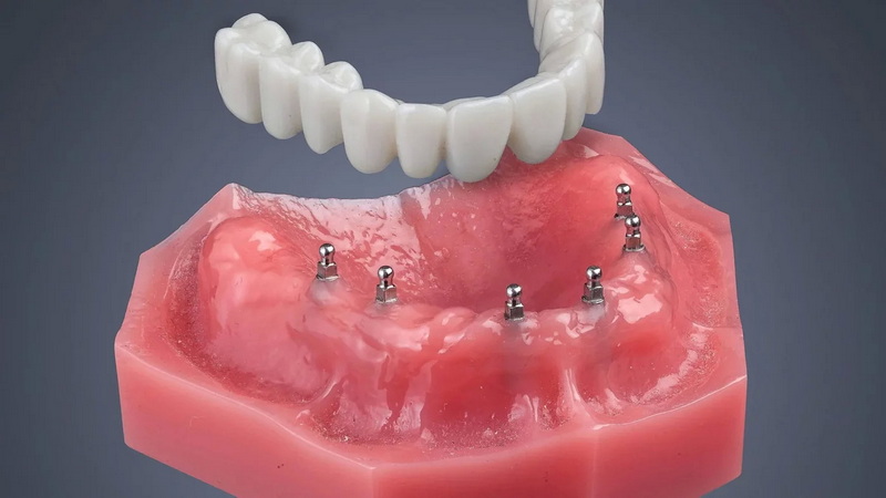 what is average cost of a full dental implant_1
