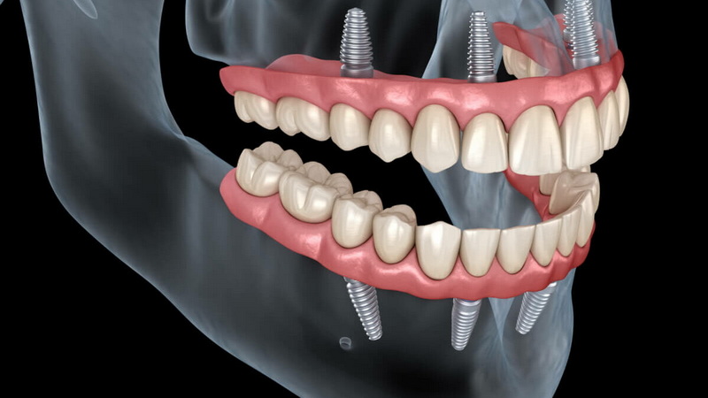 What Does A Failed Dental Implant Look Like?