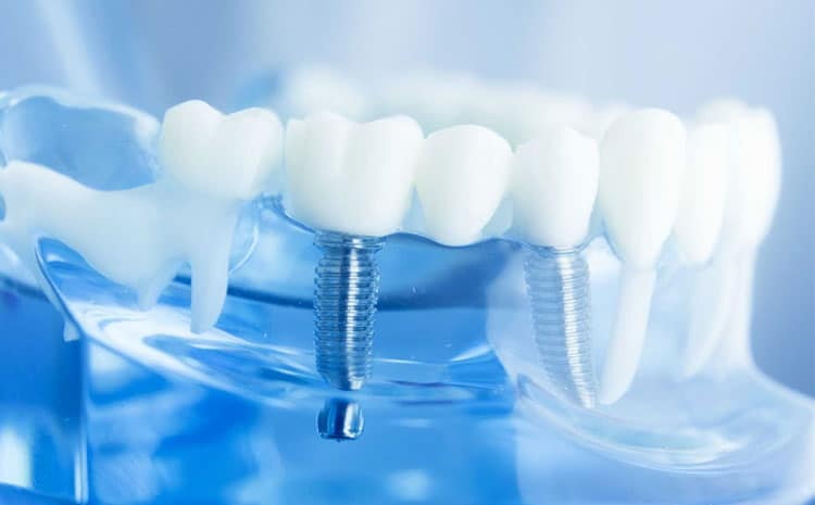 the different parts of a dental implant_1