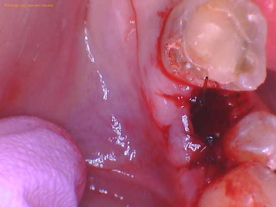 how long does dental implant healing take_04