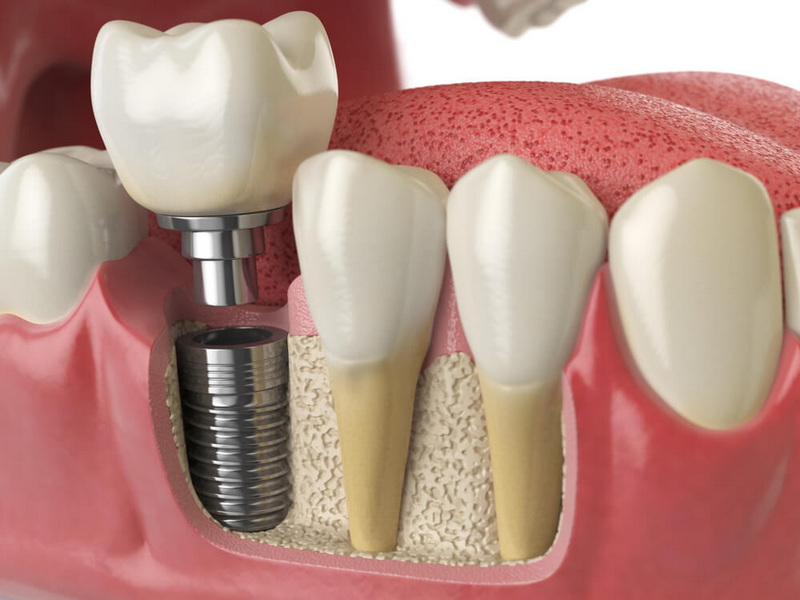 how long does dental implant healing take_08