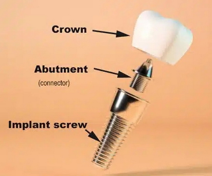 can i screw the healing abutment back in_1