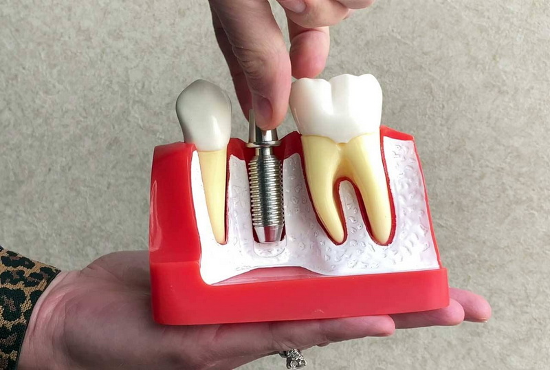 what is the percentage of dental implant failures