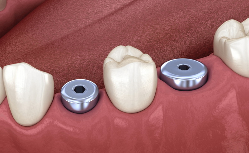 can you chew ice with dental implant