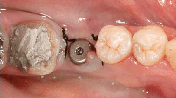 healing abutment vs final abutment
