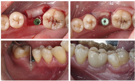 healing abutment fell out