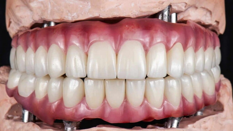 When Not To Get A Dental Implant?