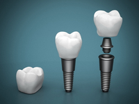 //iirorwxhloqjli5p.ldycdn.com/cloud/lmBpkKloljSRrllnolkkjo/dental-abutment-for-sale-online.jpg