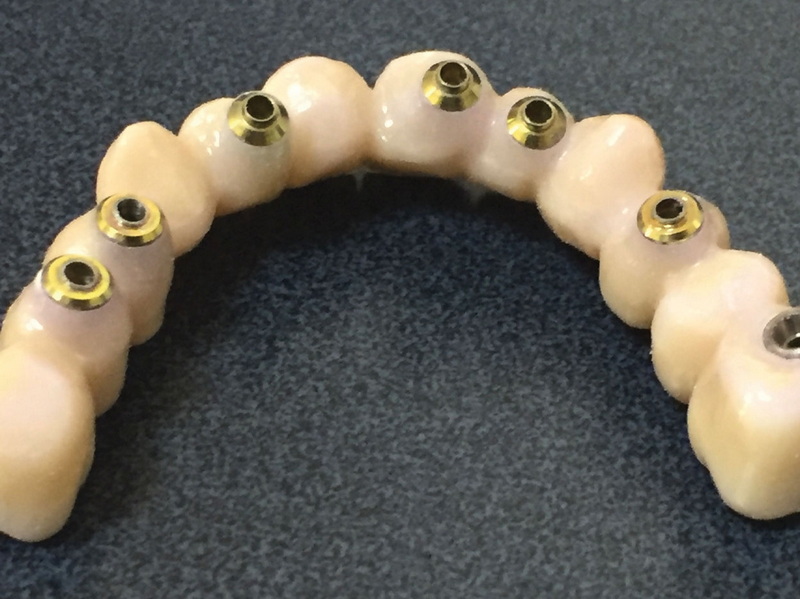 What Are The Signs of A Loose Dental Implant Abutment?