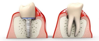 //iirorwxhloqjli5p.ldycdn.com/cloud/lmBpkKloljSRrlmlqlnojq/gingival-former-vs-healing-abutment.jpg