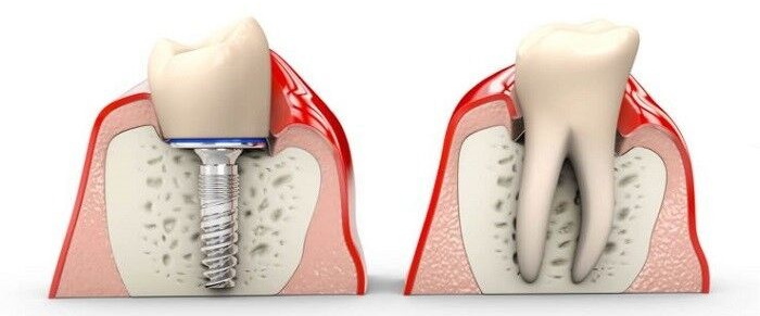 gingival former vs healing abutment