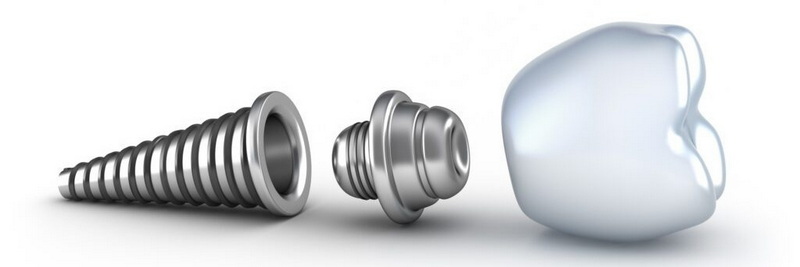 What Role Does The Abutment Play in Dental Restoration?
