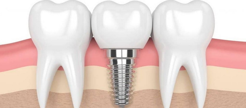 abutment screw p x a s