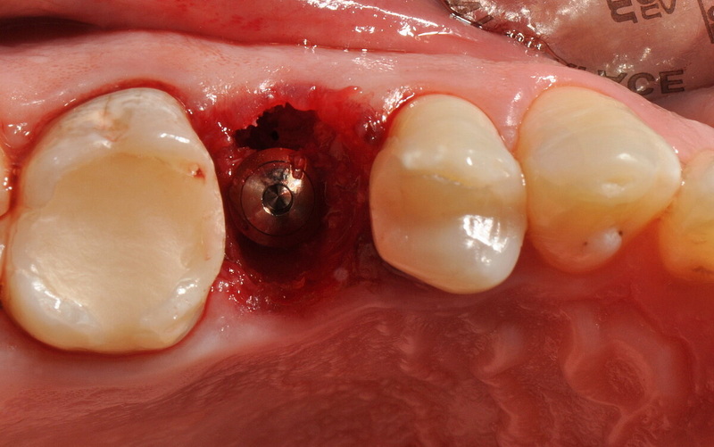 Can A Dental Implant Be Redone?