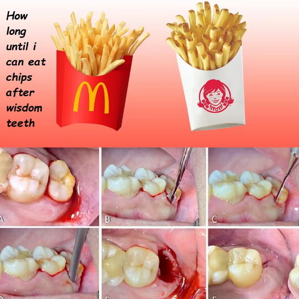 Can You Eat Chips After Dental Implant?