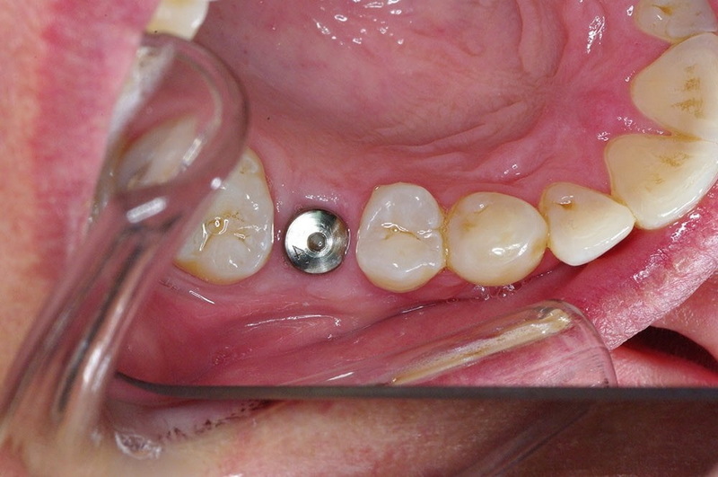 Can A Broken Abutment Screw Be Replaced Without Removing The Implant?