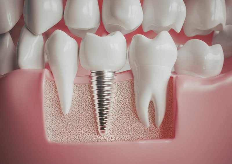 can i have a dental implant after zomeda