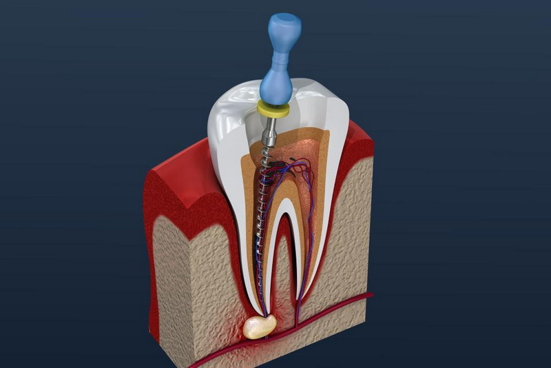 Can Infection Occur with Dental Implant?