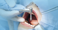 //iirorwxhloqjli5p.ldycdn.com/cloud/lmBpkKloljSRrlqlppiqjq/abutment-screw-loose.jpg