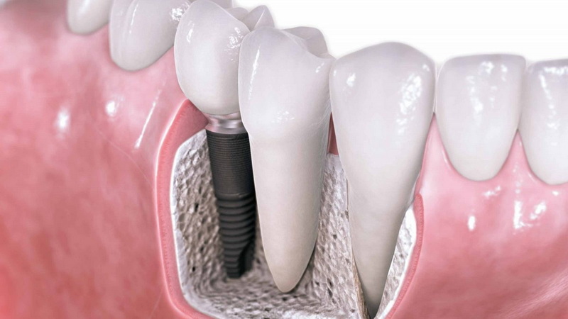 Can A Dental Implant Abscess?