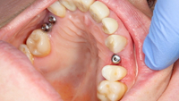 //iirorwxhloqjli5p.ldycdn.com/cloud/lmBpkKloljSRrlrliqmljo/4mm-allen-abutment-screw.jpg