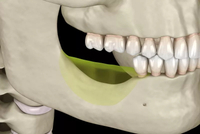 //iirorwxhloqjli5p.ldycdn.com/cloud/lmBpkKloljSRrlrlolrijn/can-you-get-a-dental-implant-2-years-after-extraction.jpg