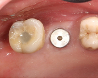 //iirorwxhloqjli5p.ldycdn.com/cloud/lnBpkKloljSRilliikmjjo/nobel-active-healing-abutment.jpg