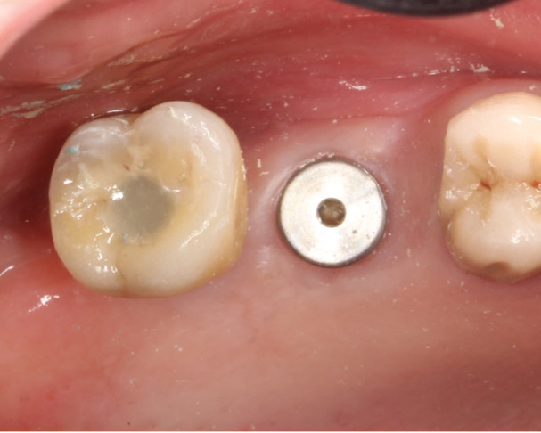 nobel active healing abutment
