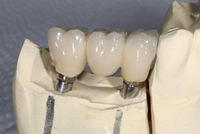 //iirorwxhloqjli5p.ldycdn.com/cloud/lnBpkKloljSRillijimkjo/implant-abutment-screw-removal.jpg