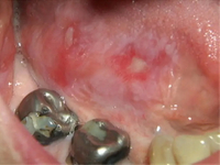 //iirorwxhloqjli5p.ldycdn.com/cloud/lnBpkKloljSRillinniljo/do-you-get-anesthesia-for-a-dental-implant.jpg