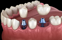 //iirorwxhloqjli5p.ldycdn.com/cloud/lnBpkKloljSRilmikjiljo/4-3mm-conelog-healing-abutment-biohorizons.jpg