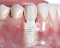 //iirorwxhloqjli5p.ldycdn.com/cloud/lnBpkKloljSRilnirijijn/do-you-need-dental-crown-after-dental-implant.jpg