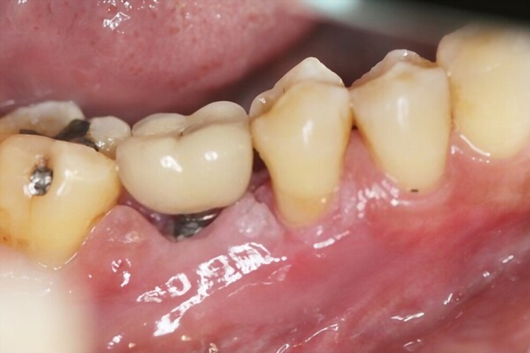 Can You Replace An Osstem Implant Abutment Screw Hex?
