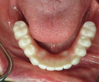 //iirorwxhloqjli5p.ldycdn.com/cloud/lnBpkKloljSRilnjmnkojq/does-a-dental-implant-need-a-crown.jpg