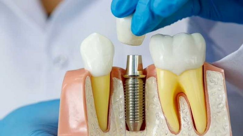 how painful is a dental implant_07