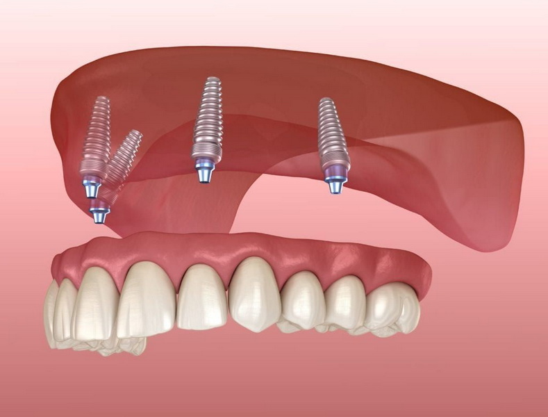 How Long Can You Eat After Dental Implant Surgery?