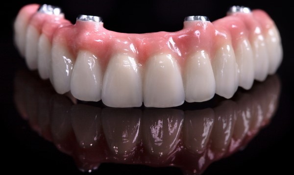 How Long After Dental Implant Can I Exercise?