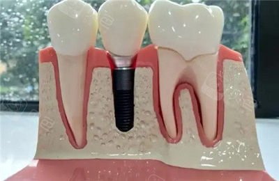 what is this dental implant_22
