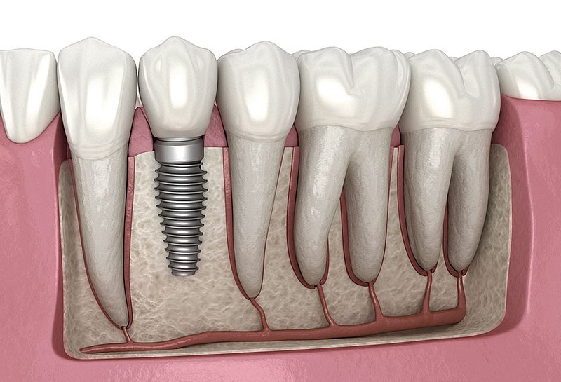 how long does a dental implant take_2