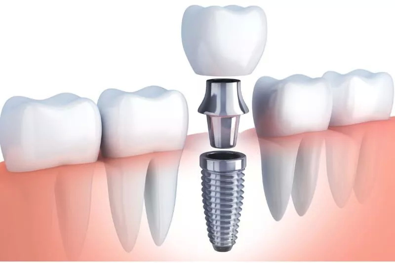 how to market dental implant