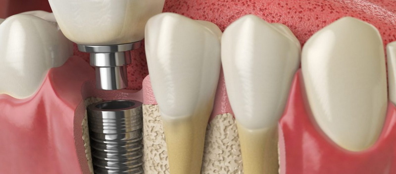 How Long Does A Dental Implant Hurt?