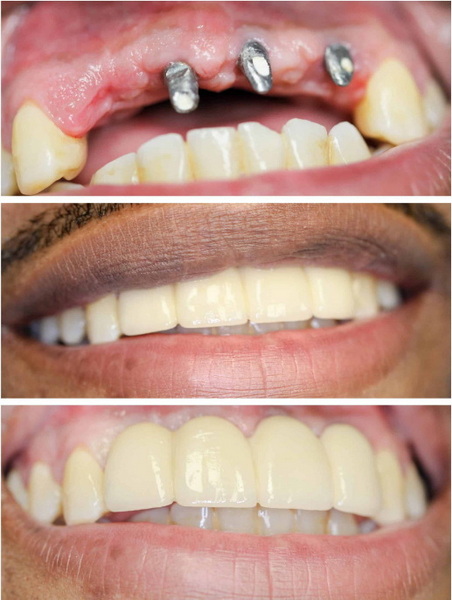can i work after dental implant_2
