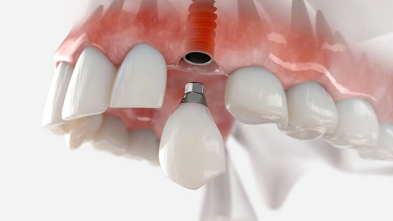 Why No Dairy After Dental Implant Reddit?