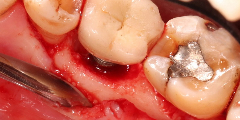 how long does it take to have a dental implant_07