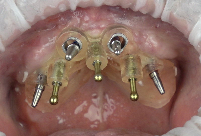 how to stop bleeding after dental implant surgery_1