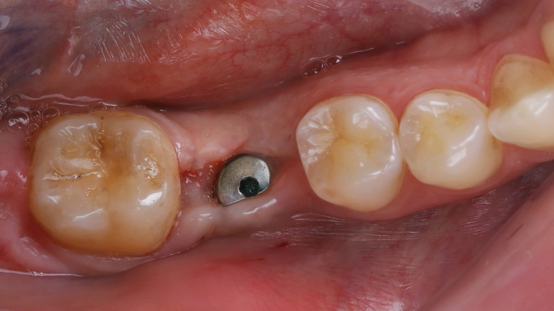 what is a dental implant arch_10